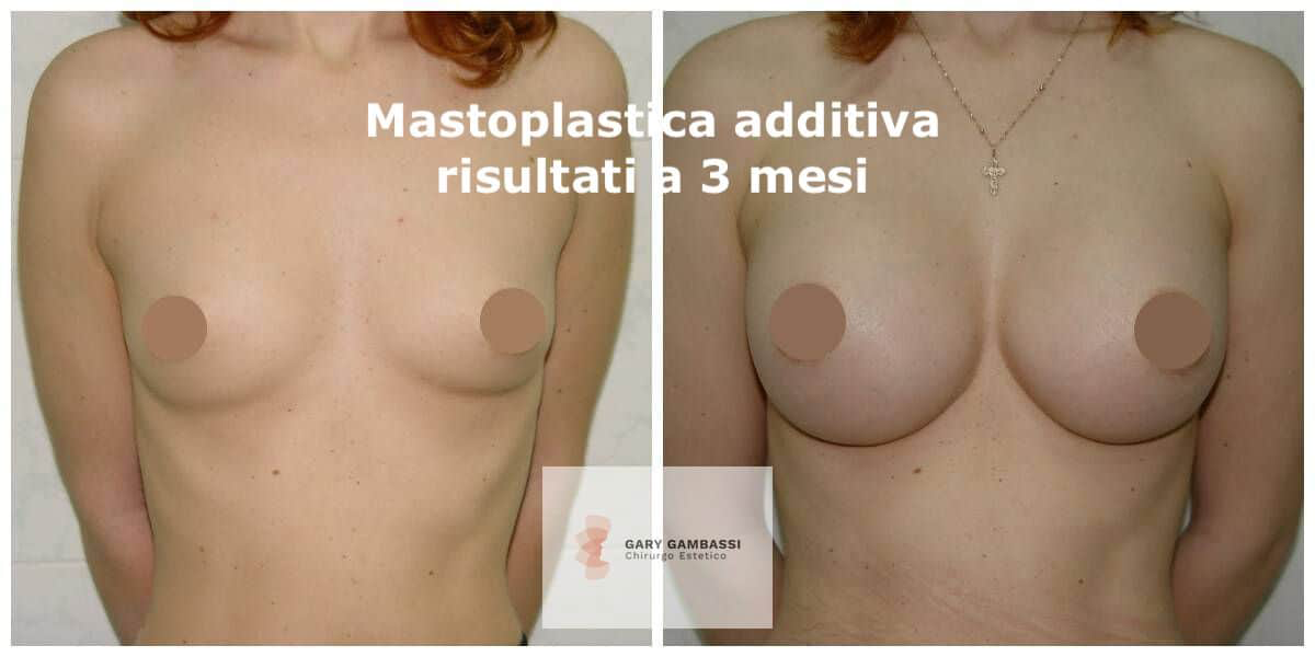 mastoplastica additiva gary gambassi chirurgo plastico serio affidabile economico